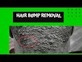 Hair Bump removals