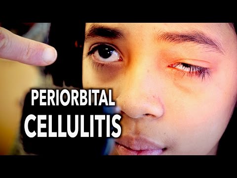 PERIORBITAL CELLULITIS (Painful!) | Dr. Paul