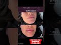 Lip filler AVANT/APRES #clinic#botoxinjection#injection#lips#lipfiller#beauty #fillereffect #fillers