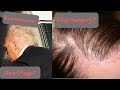 What's Going on with Donald Trump's Hair? WATCH THIS!