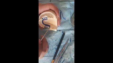 WAX PATTERN (CLASS 3 MODIFICATION 1) MANDIBULAR