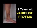 12 Years With Varicose Eczema - Shocking Lessons