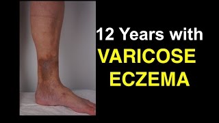 12 Years With Varicose Eczema  Shocking Lessons