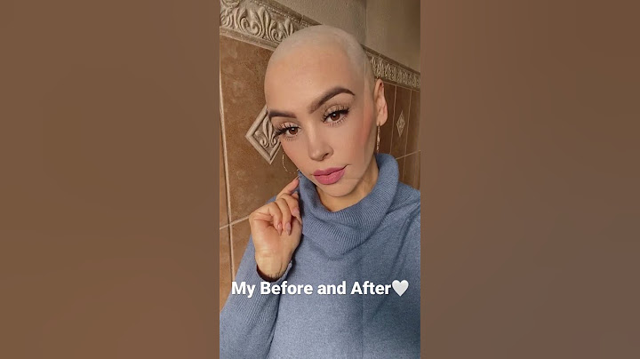 I lost my hair to Chemotherapy treatment