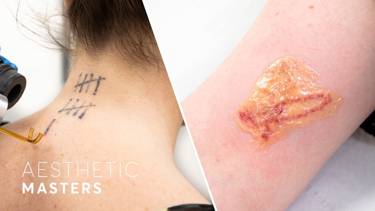 Unanswered Laser Tattoo Removal FAQs