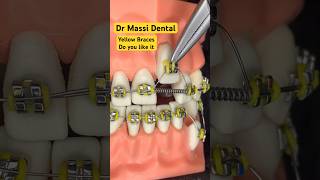Yellow BRACES, Orthodontics #youtubeshorts #viral#shorts #braces