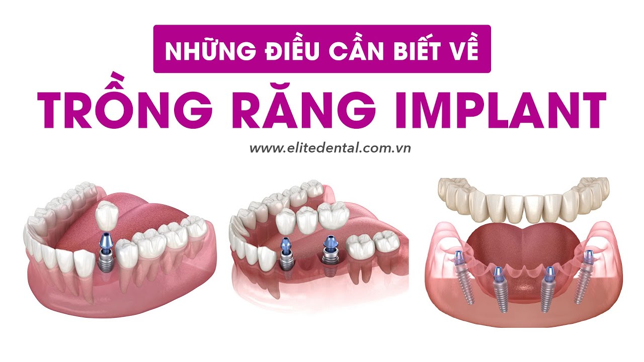 Outline Video Quy trình trồng răng Implant bao lâu và những điều cần biết