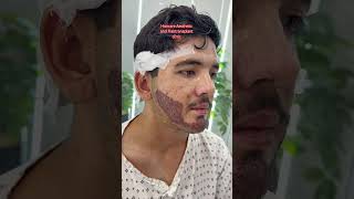 Full Density Beard Hair Transplant Amazing Natural Results successful #beautiful #hairrestoration