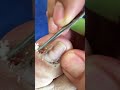 Manual cleaning of nail fungus .How to clean a nail fungus😱🦶My satisfying customer big fung