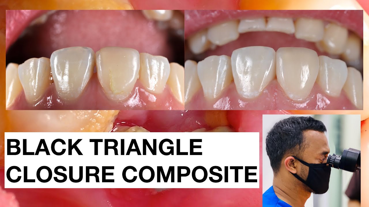 Black Triangle Closure + Class IV Composite Normal Speed Dokter