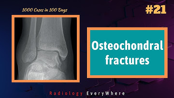 Osteochondral Fractures Radiology | 1000 cases in 100 days | Video 21 | Radiology Everywhere
