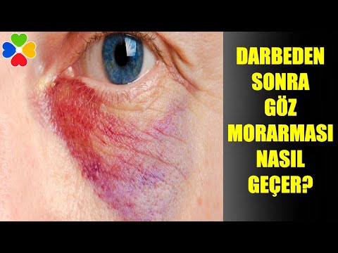 Video: Yüzdeki Morluklar Nasıl Tedavi Edilir: 12 Adım (Resimlerle)