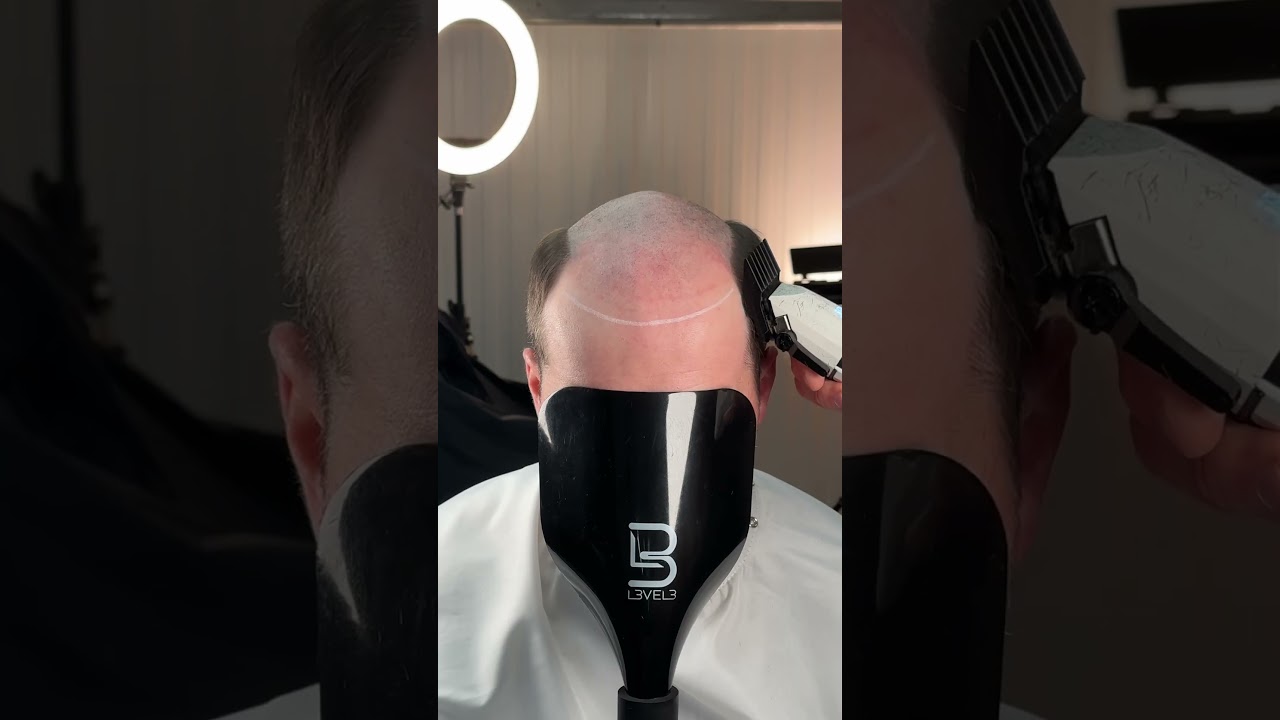 🎗️▶️ ⁠ Transforming a Bald Head with a Stunning Hair Makeover.⁠⁠