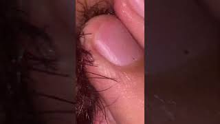 ASMR ingrown hair removal hair cut hair therapy ASMR