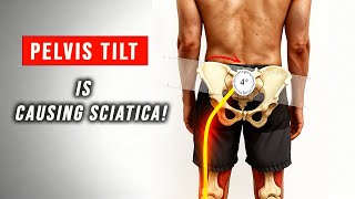 Left Pelvic Tilt & Sciatica — Exercises That Actually Work (L.AIC Pattern)