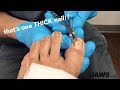 THICK INGROWN TOENAIL REMOVAL.. WOW!