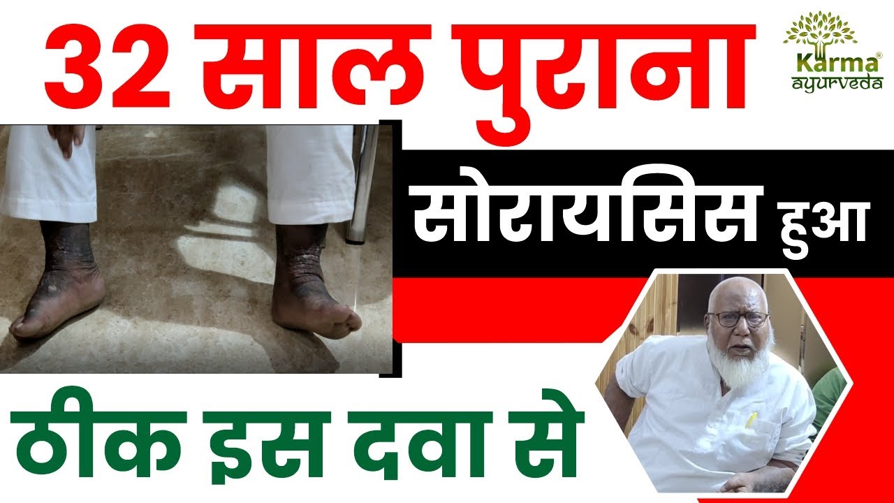 karma ayurveda reviews for psoriasis skin psoriasis treatment in