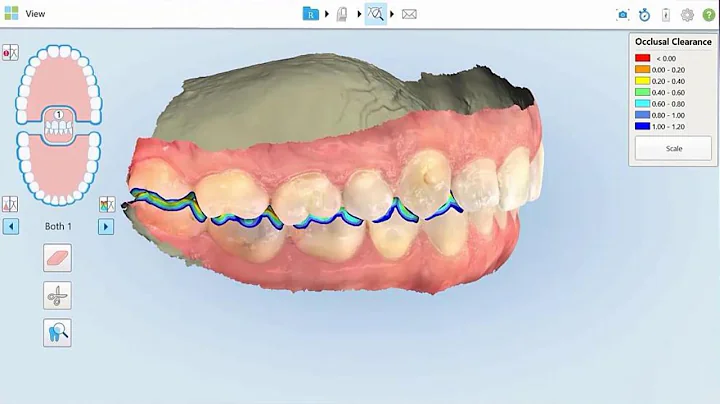 How to use multi-bite scanning  | iTero Element™ intraoral scanners guide