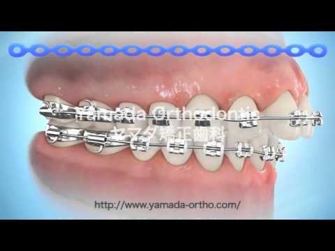 パワーチェーン結紮Elastomeric Chain Ligation (Colored full arch)