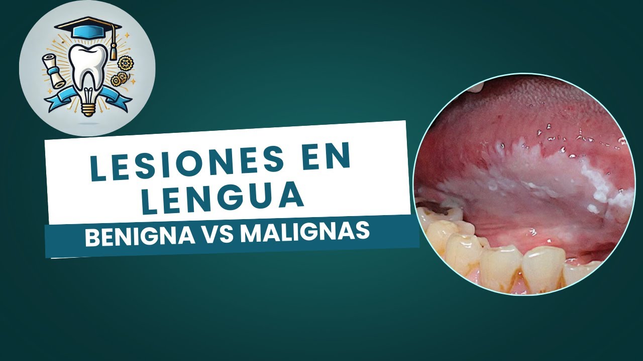 gu-a-para-reconocer-lesiones-benignas-y-malignas-en-la-lengua-youtube