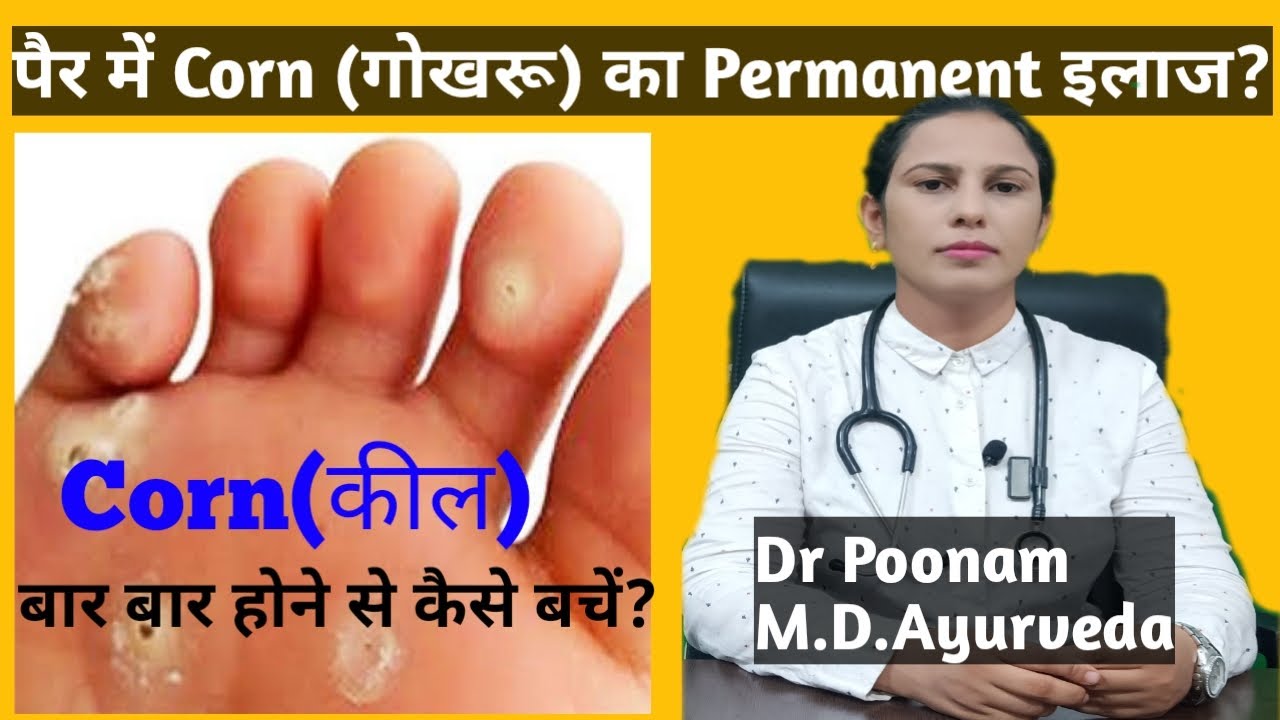 Corn treatment at home पैर के तलवे में गोखरू का इलाज Foot corn removal at home in hindi Foot