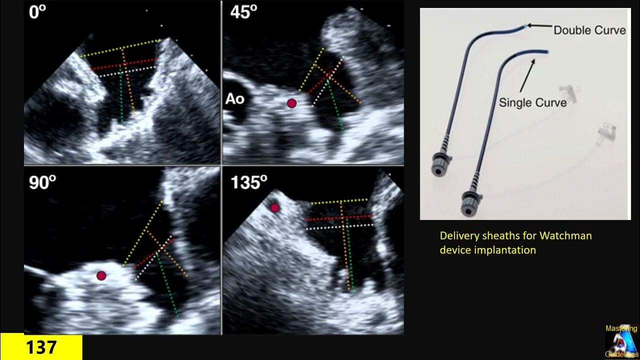 Left Atrial Appendage measurements & Watchman YouTube