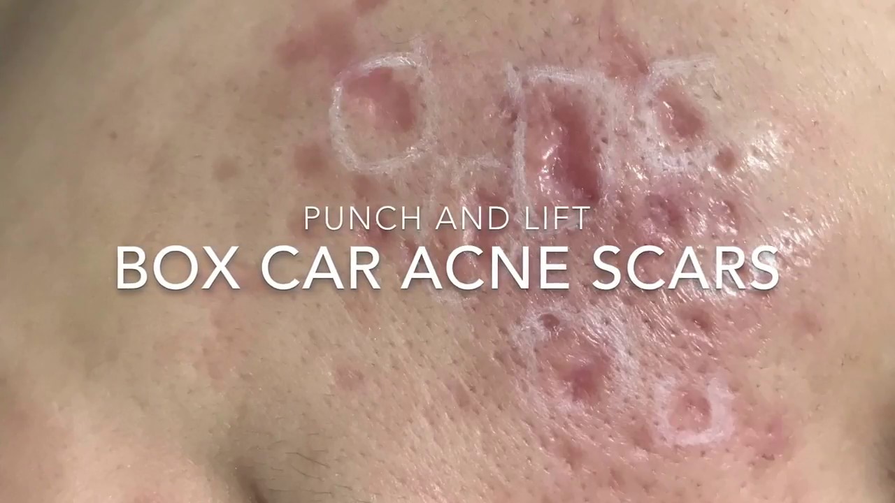 Acne scar punch lift YouTube