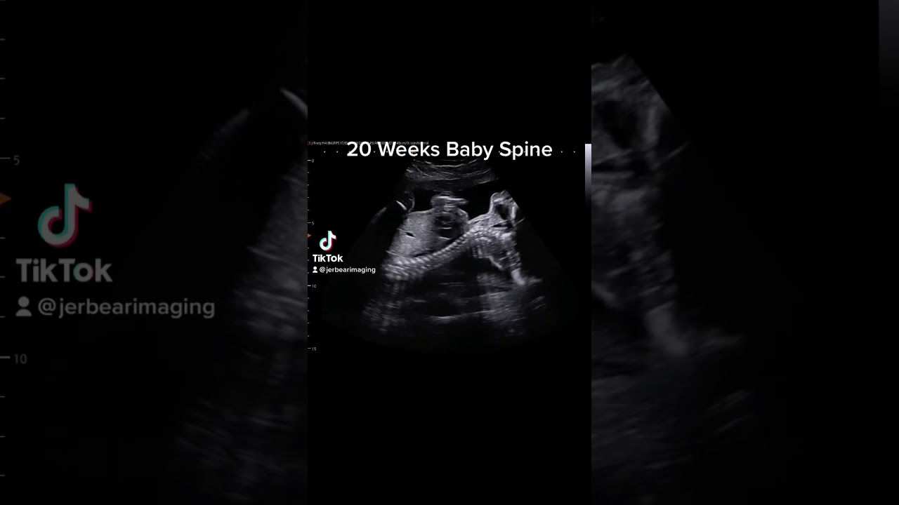 20 weeks baby spine on 2D Ultrasound 