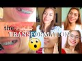 BEFORE AND AFTER BRACES | TRANSFORMATION | NABAGO TALAGA ANG NGIPIN KO | Part 1