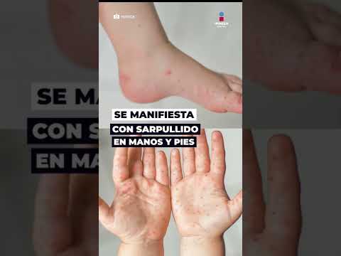 Video: Cómo saber cuándo es contagioso (con imágenes)