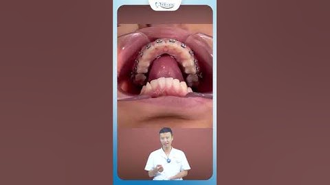 Khí Cụ Chặn Lưỡi Có Tác Dụng Gì Trong Niềng Răng | Bác Sĩ Yên