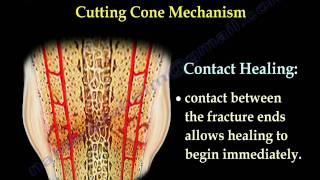 Fracture Healing Part 2 - Everything You Need to Know - Dr. Nabil Ebraheim