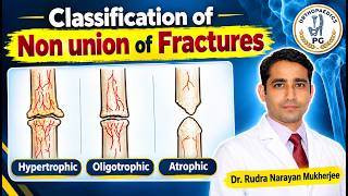 Classification of Non Union of Fractures