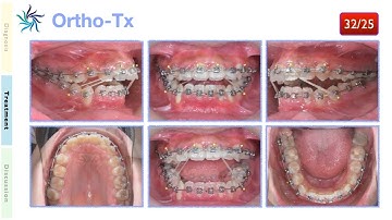 Multiple complicate impaction teeth solution｜【Chris Chang Ortho】CC665