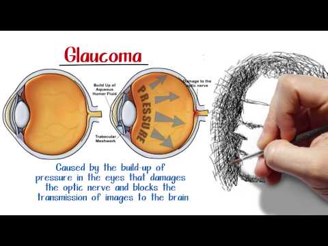 a-torrance-optometry-clinic-answers-common-questions-about-glaucoma