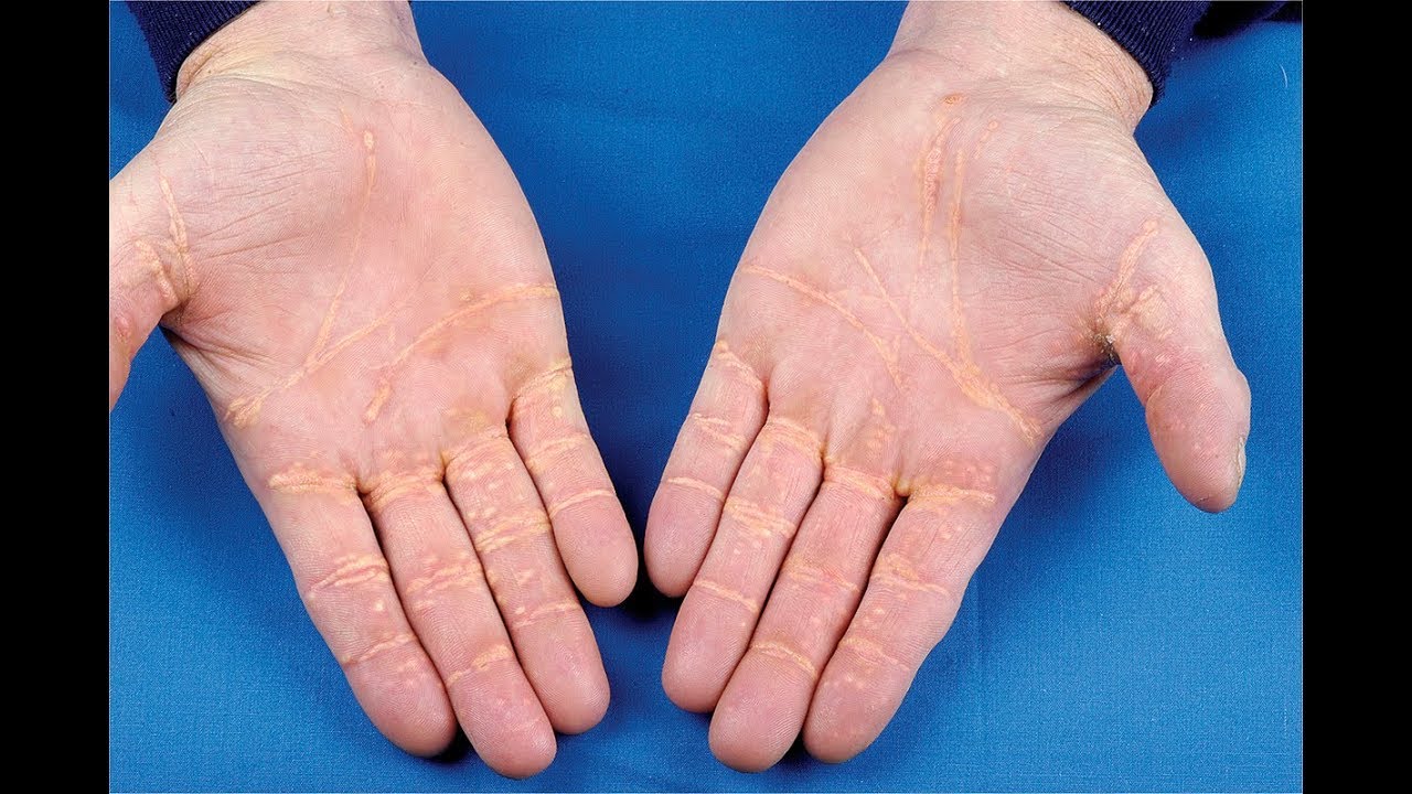 Xanthoma striatum palmare 
