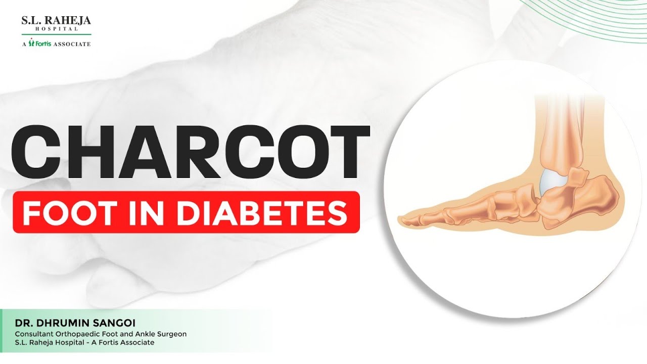 Sl Rh Diabetes Mein Charcot Foot Kaise Develop Hota Hai? | Charcot Foot in ...