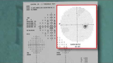 Visual Fields (Chapter 6 of 7)