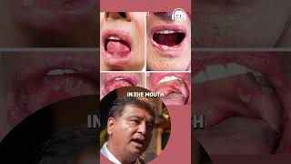 Precancerous Condition Explained In Hindi