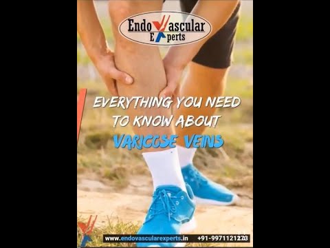 Everything you need to know about Varicose Veins Best Animation Video ...