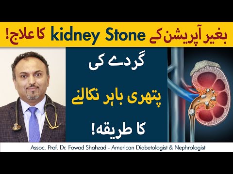 Kidney Stones Ko