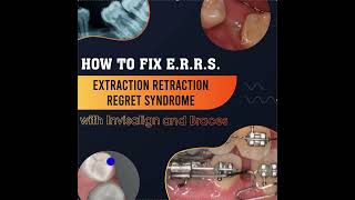 Using Invisalign to Fix E.R.R.S. (Extraction, Retraction, Regret Syndrome)