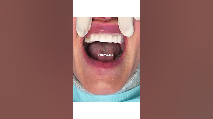 Full mouth rehabilitation | full mouth crowns before and after | dental crowns procedure | Dr.Yazdan