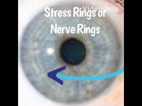 Iridology- Nerve or Stress Rings - YouTube