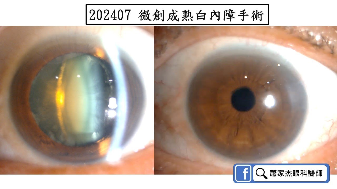 202407 微創成熟白內障手術| Cataract Surgery - YouTube