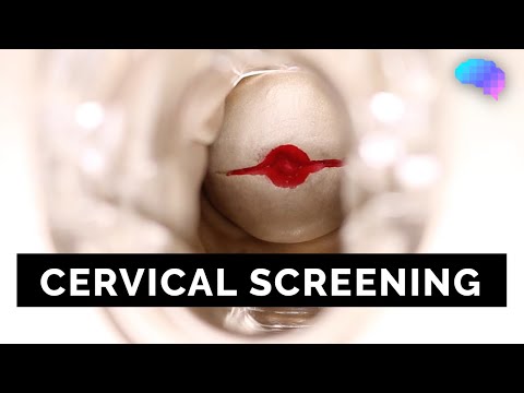 Cervical Screening (SMEAR) - OSCE Guide