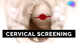 Cervical Screening (SMEAR) - OSCE Guide | UKMLA | CPSA Resimi