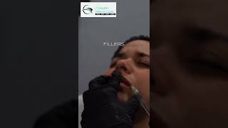 Botox Vs Lip Filler