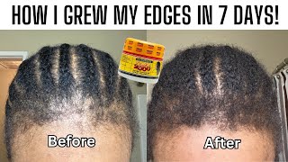 HOW TO GROW YOUR EDGES, BALD SPOTS, ALOPECIA & THIN HAIR FAST! SKIP THE HAIR TRANSPLANT IN TURKEY!