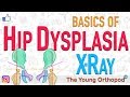 Developmental Dysplasia of Hip, DDH X Ray features, NEET PG, USMLE, Dysplastic hip, CDH